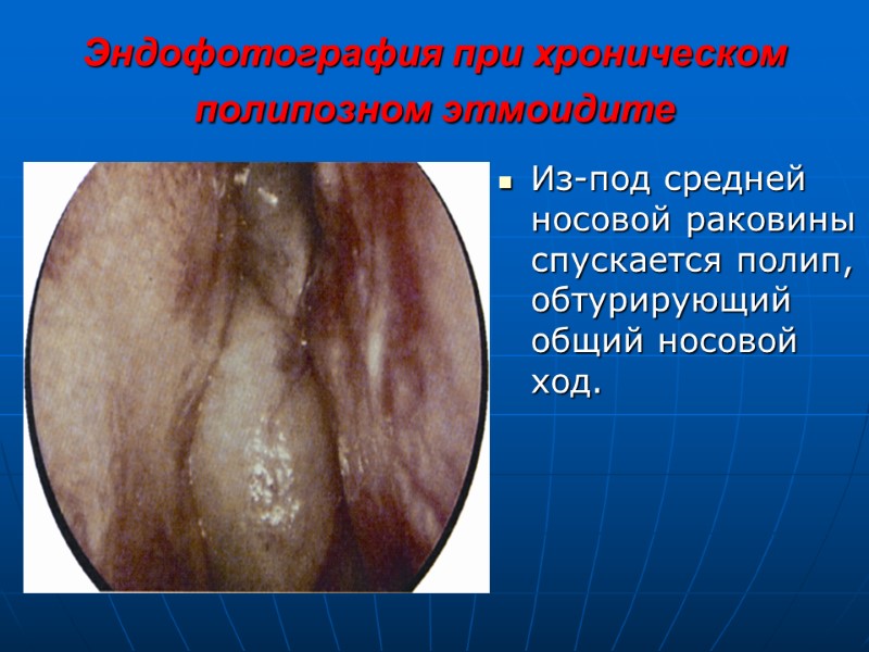Эндофотография при хроническом полипозном этмоидите  Из-под средней носовой раковины спускается полип, обтурирующий общий